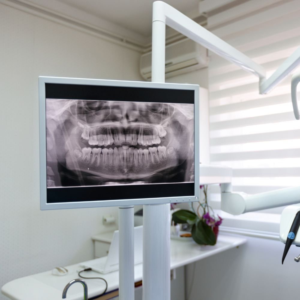 Digital X-Rays (If Required)